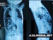 Танасидан 16та игна топилган чақалоқ тирик. Вазирлик расмий хабар берди