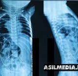 Танасидан 16та игна топилган чақалоқ тирик. Вазирлик расмий хабар берди