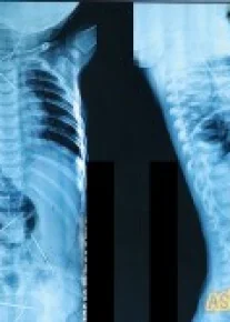 11 ойлик чақалоқнинг танасидан 16 дона игна топилди