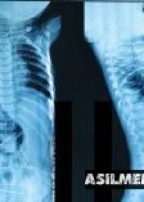 Танасидан 16та игна топилган чақалоқ тирик. Вазирлик расмий хабар берди